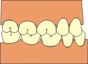 malocclusione dentale